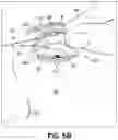 Fig. 05 - Instrument for treating an ocular disorder