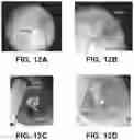 Fig. 11 - Shape changing drug delivery devices and methods