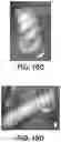 Fig. 17 - Shape changing drug delivery devices and methods
