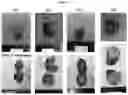 Fig. 10 - Composition for hepatic arterial chemoembolization using human serum albumin nanoparticles carrying anticancer agent, and method for producing same