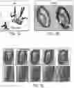 Fig. 02 - RAPIDLY IMPROVING VASCULAR CONDITIONS BY ADMINISTERING VITAMIN K