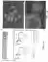 Fig. 02 - THERAPY AND METHODS OF INTRODUCING IMMATURE DENDRITIC CELLS AND/OR CYTOXIC T LYMPHOCYTE AND ANTI PD-1 / PD-L1 ANTIBODY FOR TREATMENT OF TUMORS