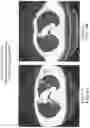 Fig. 07 - THERAPY AND METHODS OF INTRODUCING IMMATURE DENDRITIC CELLS AND/OR CYTOXIC T LYMPHOCYTE AND ANTI PD-1 / PD-L1 ANTIBODY FOR TREATMENT OF TUMORS