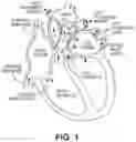 Fig. 02 - Intravascular pump with expandable region at least partially collapsible into recesses defined between impeller blades