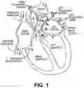 Fig. 02 - Intravascular pump with expandable and collapsible inlet region and methods thereof