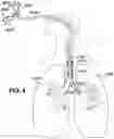 Fig. 08 - MEDICAL TUBES FOR SELECTIVE MECHANICAL VENTILATION OF THE LUNGS