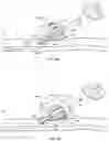 Fig. 11 - System for anchoring medical devices