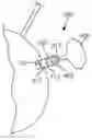 Fig. 01 - Devices and Methods for Treating Congestive Heart Failure, Ascites, and Other Disorders Relating to Excess Bodily Fluid