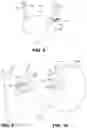 Fig. 04 - Devices and Methods for Treating Congestive Heart Failure, Ascites, and Other Disorders Relating to Excess Bodily Fluid