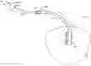 Fig. 01 - Catheter system for draining a bodily fluid from a fluid source in a body