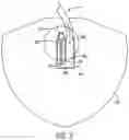 Fig. 03 - Catheter system for draining a bodily fluid from a fluid source in a body
