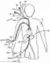 Fig. 01 - In vivo gene therapy delivery procedure and device