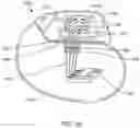 Fig. 22 - Method of manufacturing a singulated feedthrough insulator for a hermetic seal of an active implantable medical device incorporating a post conductive paste filled pressing step