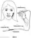 Fig. 06 - Attachable tip for electromagnetic hand piece