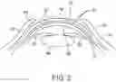 Fig. 04 - Contact lens with a hydrophilic layer