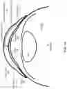 Fig. 02 - Electrical interconnects within electronic contact lenses