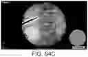 Fig. 71 - Imaging system and method for image localization of effecters during a medical procedure