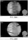 Fig. 72 - Imaging system and method for image localization of effecters during a medical procedure