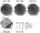 Fig. 05 - Patterning platinum by alloying and etching platinum alloy