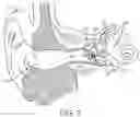 Fig. 03 - HEARING SYSTEM HAVING IMPROVED HIGH FREQUENCY RESPONSE