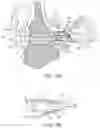 Fig. 05 - HEARING SYSTEM HAVING IMPROVED HIGH FREQUENCY RESPONSE