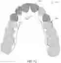 Fig. 20 - Analysis and visualization of a dental arch under a limited accuracy system