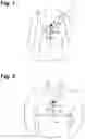 Fig. 02 - Extended wear electrocardiography and physiological sensor monitor