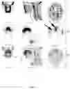 Fig. 12 - Diagnosing reflux disease