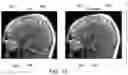 Fig. 12 - Plane selection using localizer images