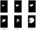 Fig. 01 - GENERATING A SOURCE POINT OF SHEAR WAVES FOR SHEAR WAVE ELASTICITY IMAGING