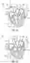 Fig. 12 - Methods for occluding or promoting fluid flow