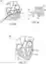 Fig. 14 - Methods for occluding or promoting fluid flow