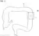 Fig. 09 - Method of delivering and recovering curved needle