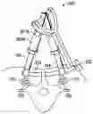 Fig. 01 - Percutaneous Transverse Connector System