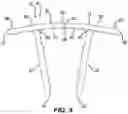 Fig. 04 - METHOD AND APPARATUS FOR A CONTINUOUS COMPRESSION IMPLANT