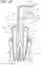 Fig. 11 - Apparatus, methods, and compositions for endodontic treatments