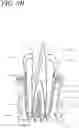 Fig. 13 - Apparatus, methods, and compositions for endodontic treatments