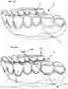 Fig. 02 - Retainer Engaging the Gums and a Method for Creating Such