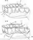 Fig. 03 - Retainer Engaging the Gums and a Method for Creating Such