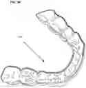 Fig. 04 - Retainer Engaging the Gums and a Method for Creating Such
