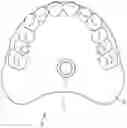 Fig. 01 - Prosthesis as well as retrofit kit for a prosthesis