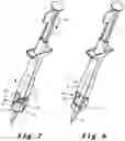 Fig. 04 - Flexible intraocular lens injection device and storage shuttle for implementing same