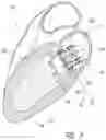 Fig. 04 - Vascular implant and delivery system