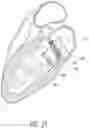 Fig. 37 - Vascular implant and delivery system