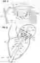 Fig. 03 - Percutaneous mitral valve replacement device