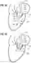 Fig. 12 - Percutaneous mitral valve replacement device