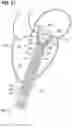Fig. 20 - Percutaneous mitral valve replacement device