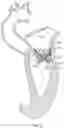 Fig. 03 - Transcatheter valve prosthesis and a concurrently delivered sealing component