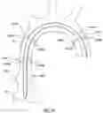 Fig. 08 - Delivery system having an integral centering mechanism for positioning a valve prosthesis in situ