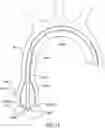 Fig. 13 - Delivery system having an integral centering mechanism for positioning a valve prosthesis in situ